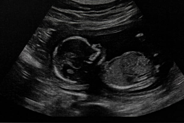 The Importance of Anomaly Scan in the Second Trimester