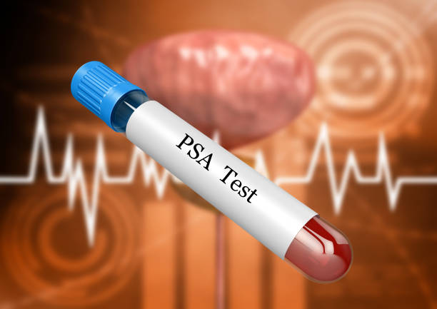 Understanding Total and Free PSA Levels in Prostatic Cancer