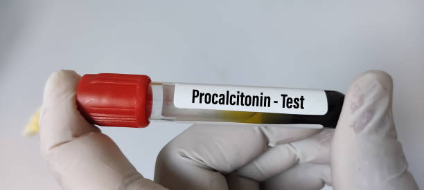 Procalcitonin; An Essential Marker for Detecting Sepsis