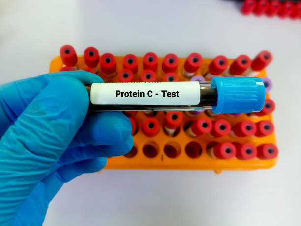 Detecting Protein Deficiency Through Blood Tests