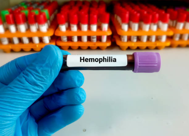 Unlocking the Mystery of Haemophilia