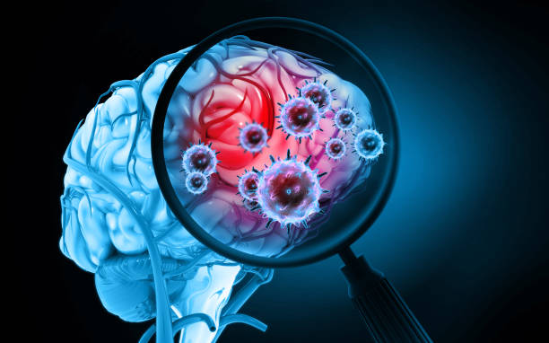 Encephalitis Panel Test