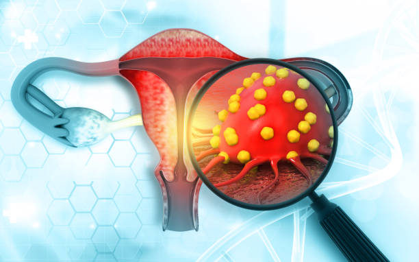 Cervical Cancer and Screening Methods