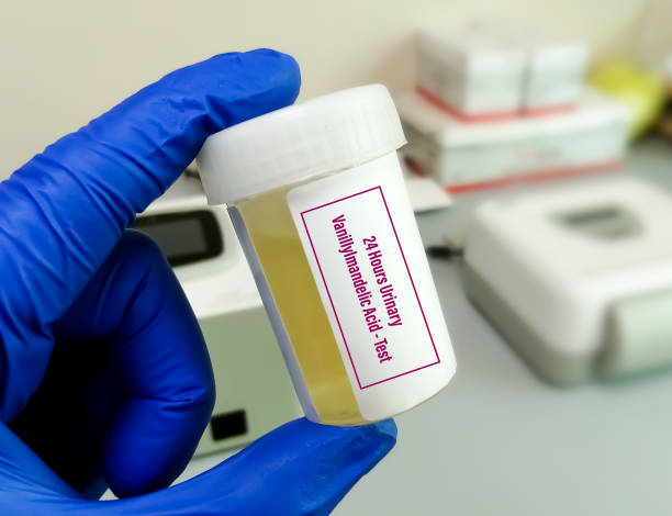 Urinary VMA and metanephrine and carcinoid syndrome 