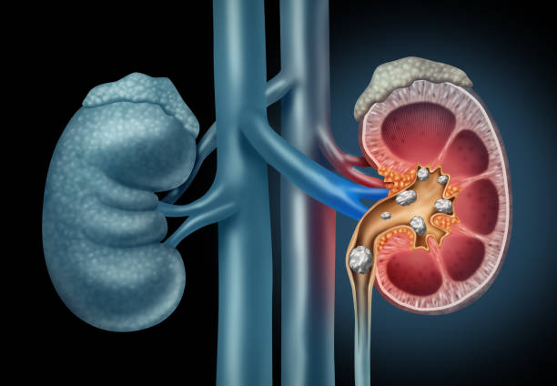 Role of Urine Citrate and Oxalate in Kidney Stone Formation