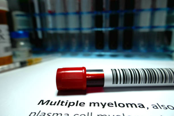 Things You Must Know About Multiple Myeloma